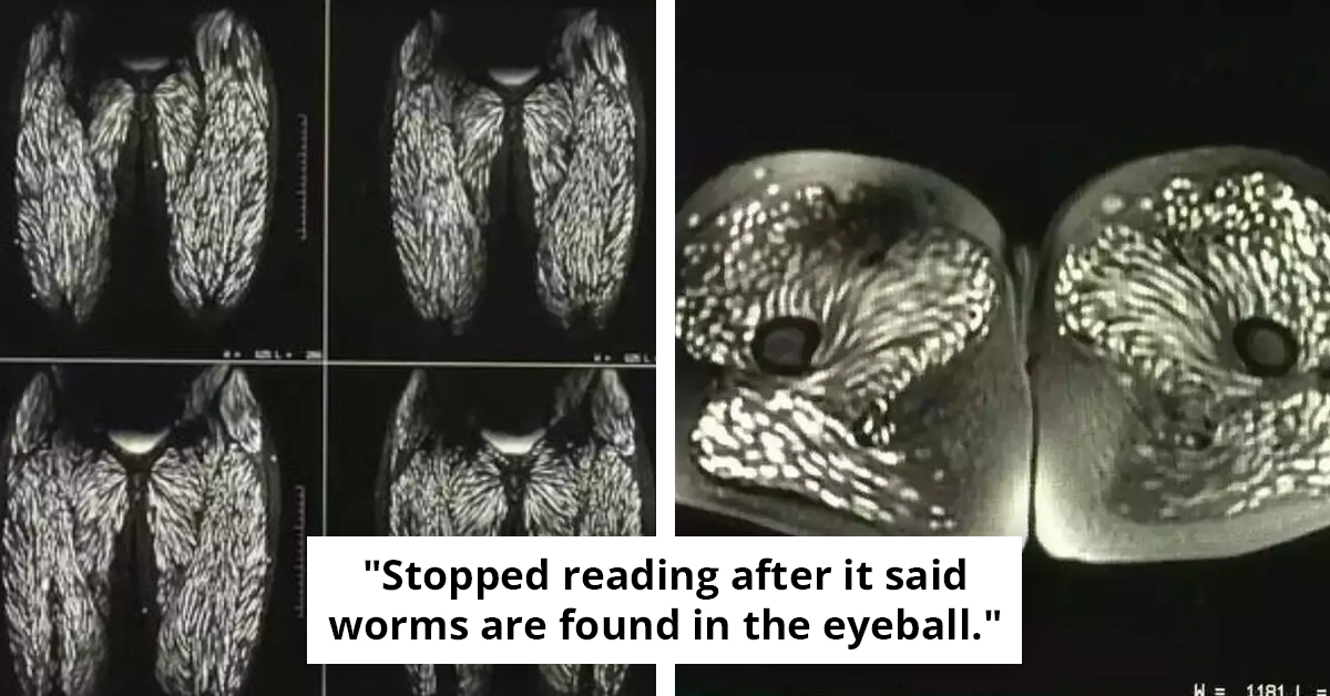 A Decade Of Eating Certain Type Of Meat Left Woman’s Body Infested With Parasites