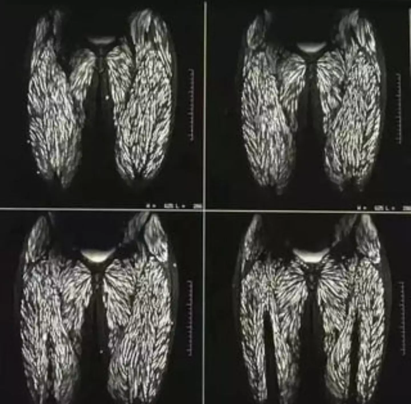 The X-ray images of Tingting's parasite-infested body have sparked widespread disgust and concern online.