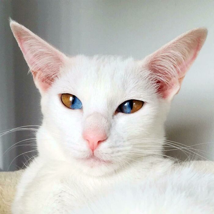 10. Sectoral heterochromia: a unique eye trait.