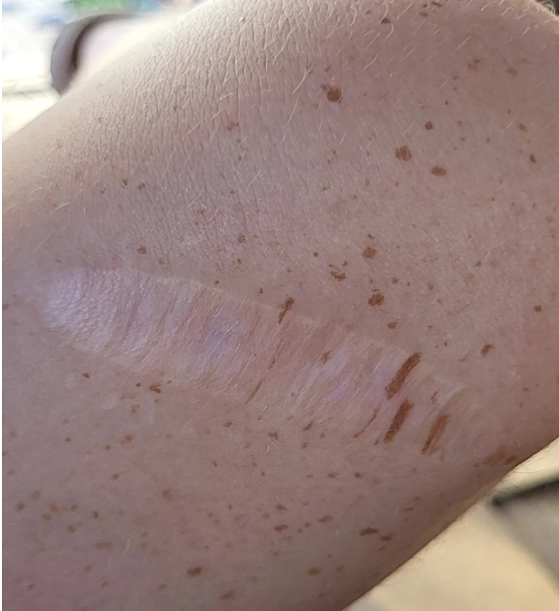 8. "Stretched freckles surrounding an old cut."